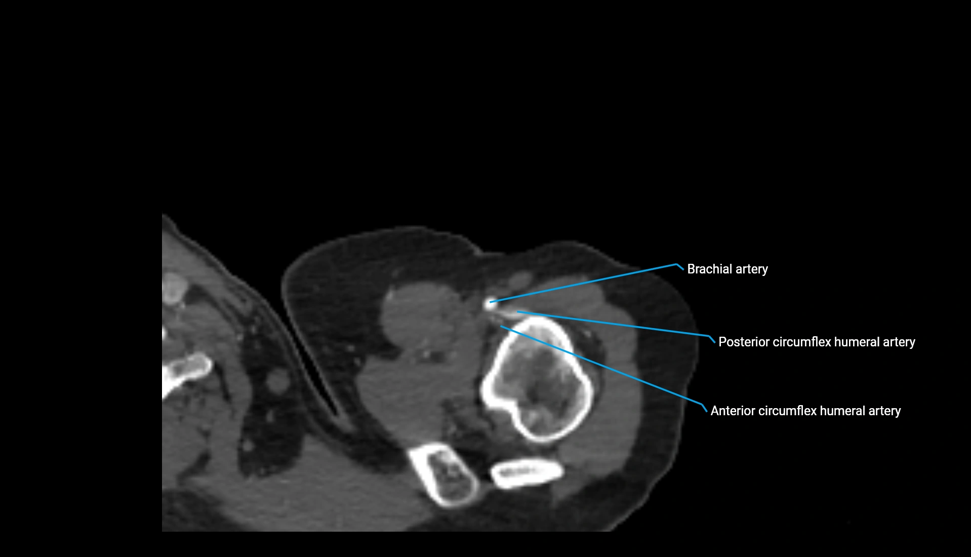 CTA upper limb axial cross sectional anatomy labelled image 318 (1).webp